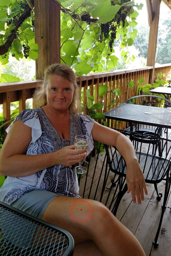 This is my melanoma story. I’m telling you my story in hopes that it will save someone's life. Help me raise awareness SHARE WITH FAMILY AND FRIENDS PLEASE! | TheMountainKitchen.com