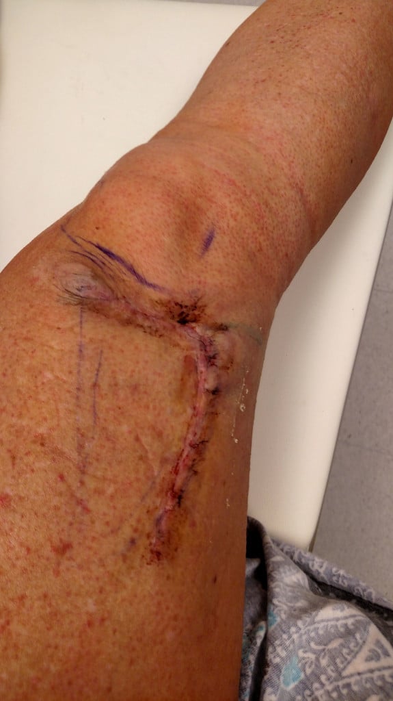 This is my melanoma story. I’m telling you my story in hopes that it will save someone's life. Help me raise awareness SHARE WITH FAMILY AND FRIENDS PLEASE! | TheMountainKitchen.com