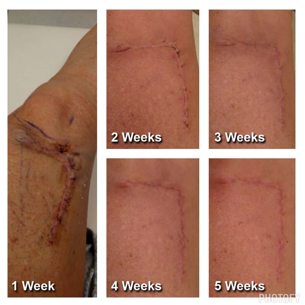 This is my melanoma story. I’m telling you my story in hopes that it will save someone's life. Help me raise awareness SHARE WITH FAMILY AND FRIENDS PLEASE! | TheMountainKitchen.com