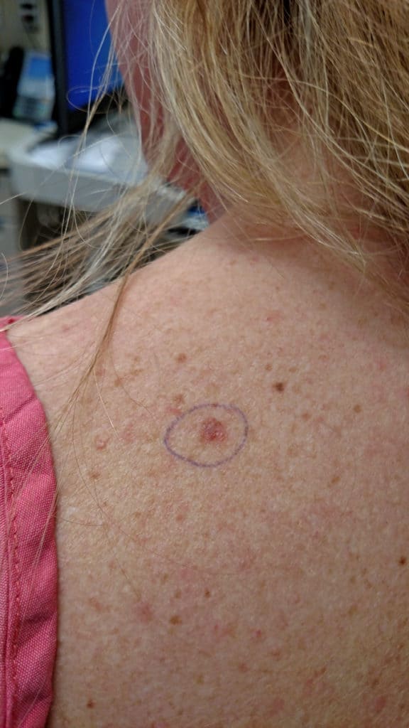 Learning to live as a melanoma survivor.