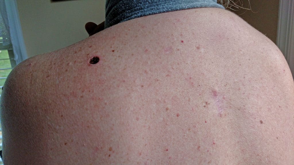 Learning to live as a melanoma survivor.