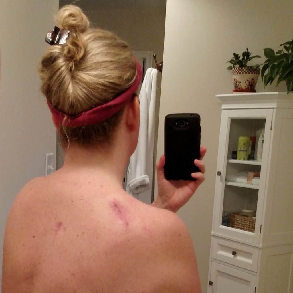 Another 3-Months…Another skin check. Today I go in for my third skin check since having melanoma removed from my leg last December. | TheMountainKitchen.com