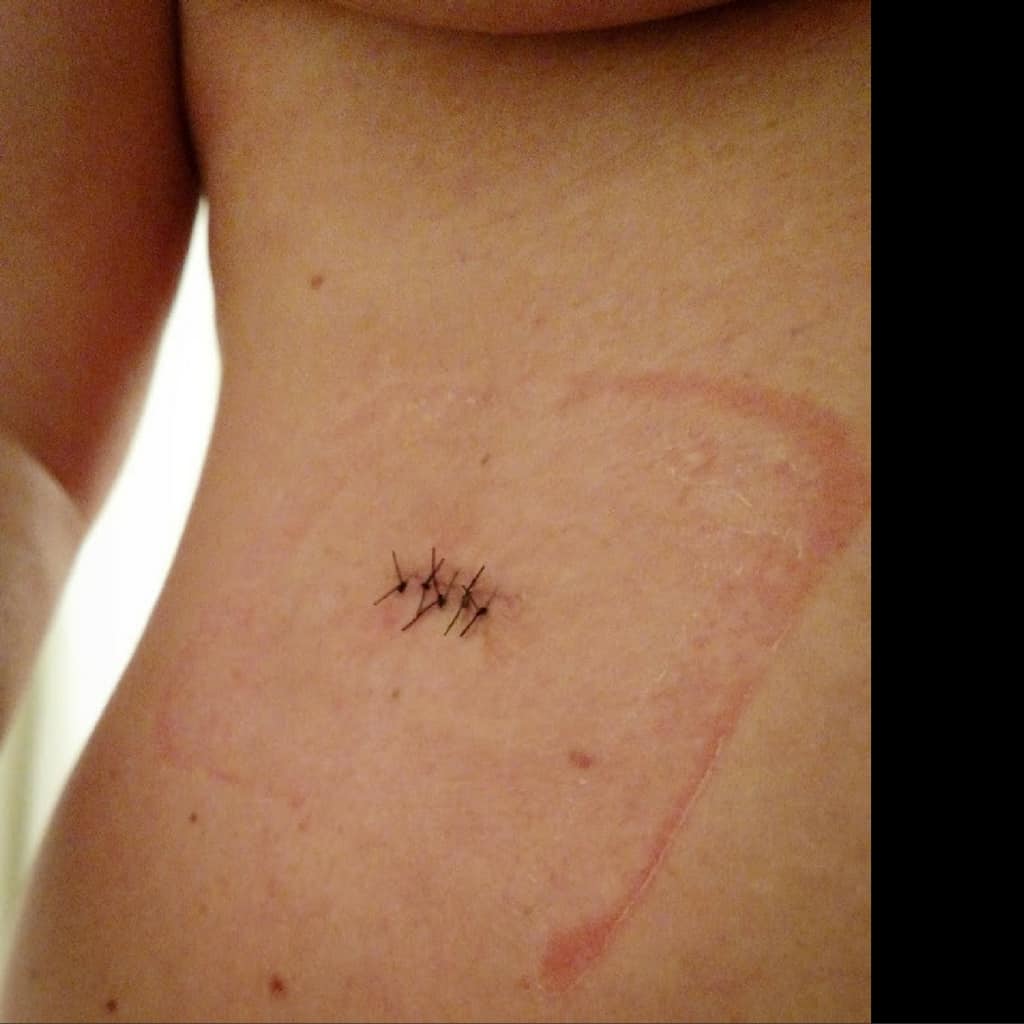 bare torso with scar