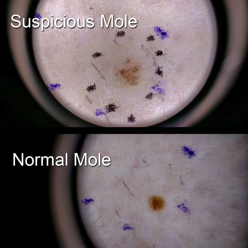 Facing the fear of melanoma and overcoming it is not easy, but it is important that you don't let the fear of melanoma keep you from getting checked out. | TheMountainKitchen.com