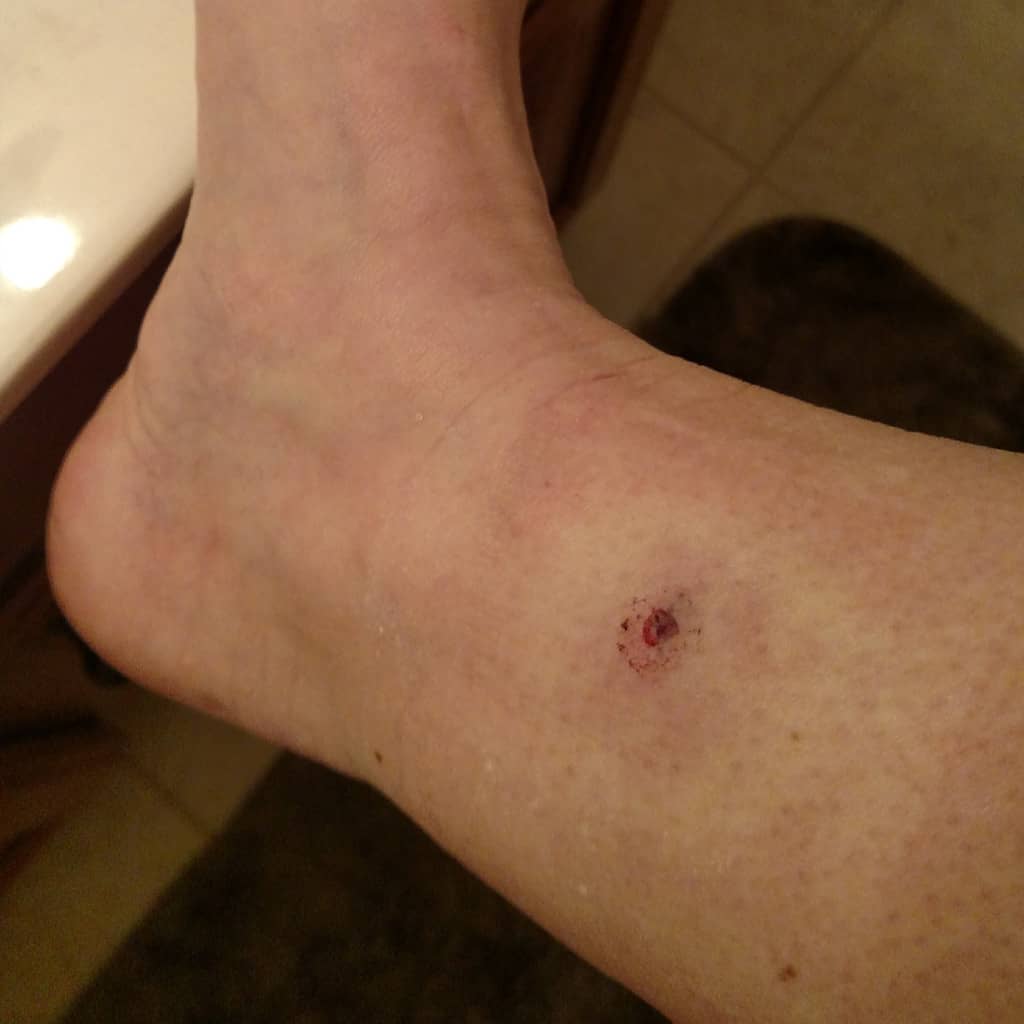 Facing the fear of melanoma and overcoming it is not easy, but it is important that you don't let the fear of melanoma keep you from getting checked out. | TheMountainKitchen.com