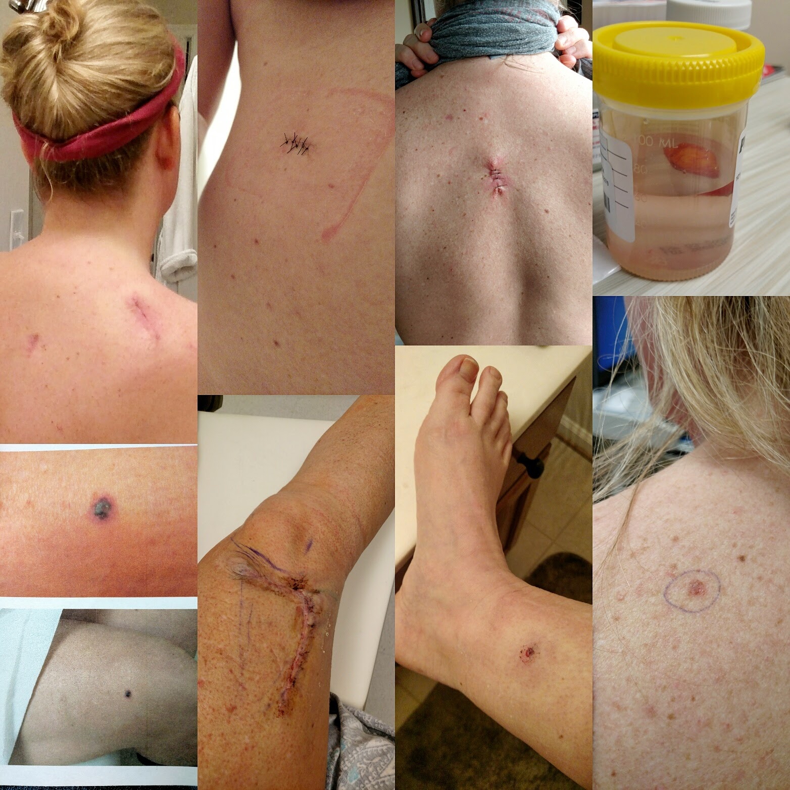 images of skin biopsies